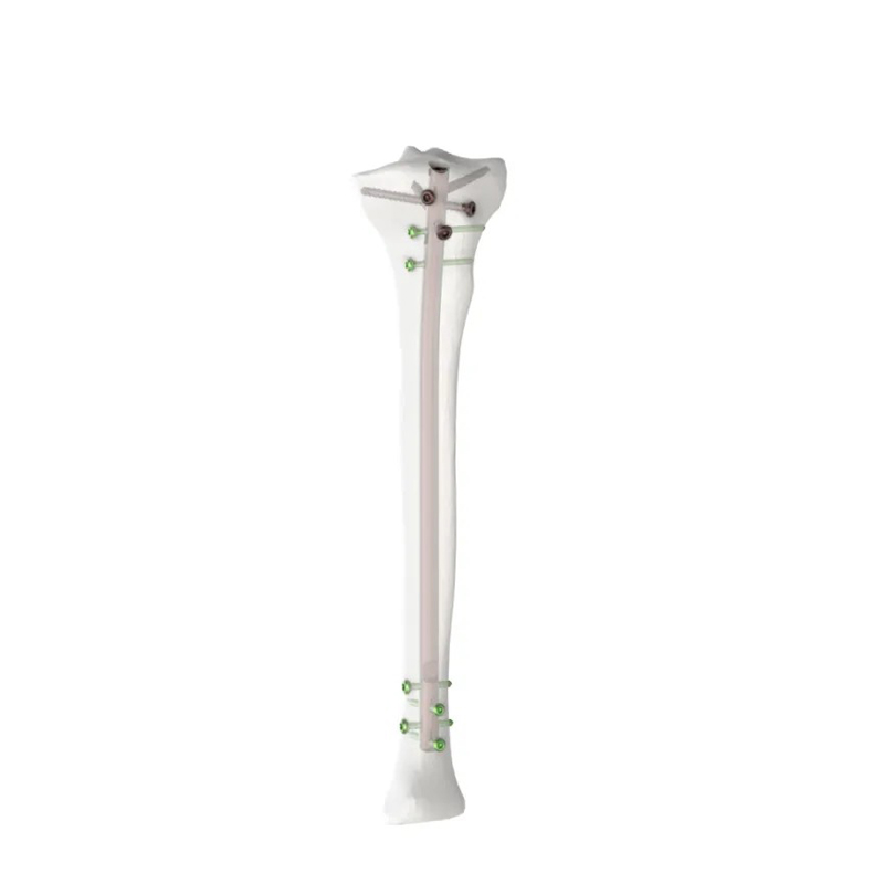 Haste Intramedular Tibia Expert | Implante Ortopédico de Titânio
