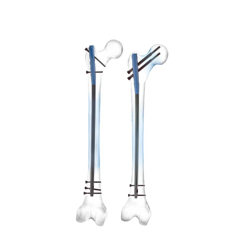 Haste intramedular femoral especializada