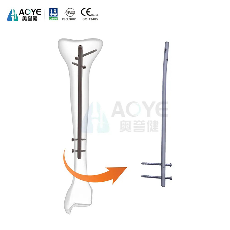 Haste Tibial Intramedular