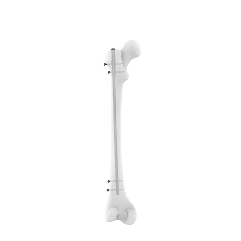 Haste intramedular femoral